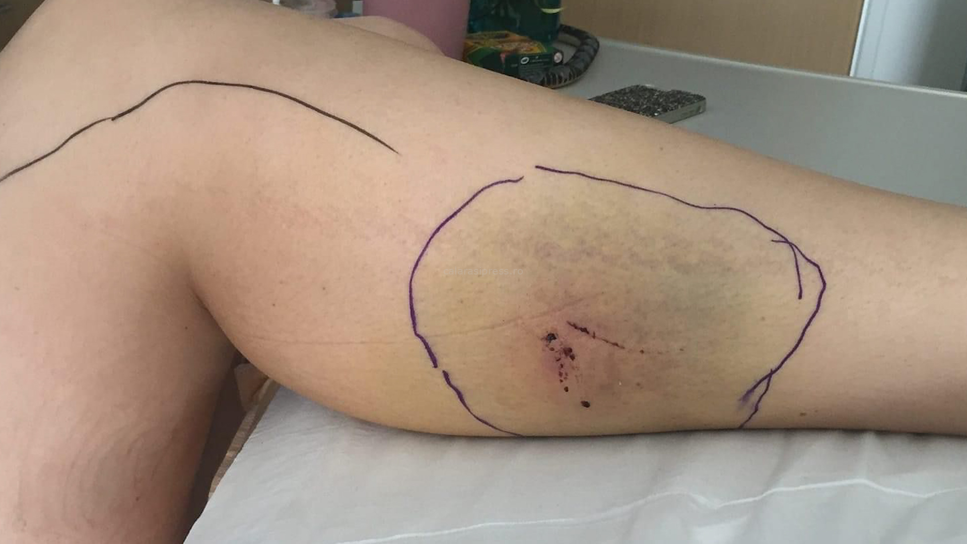 Adolescentă de 15 ani din Oltenița, muscată de șarpe